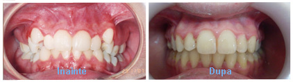aparat dentar caz 3