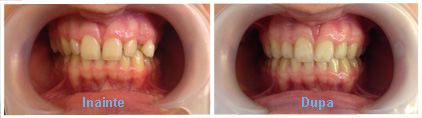 aparat dentar caz 4